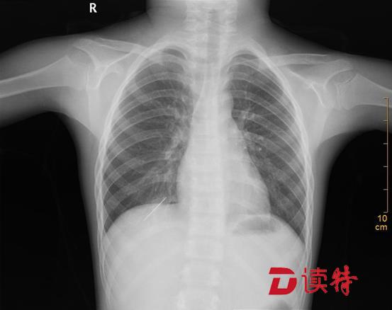 孩子不慎将6厘米长针扎入体内，差点就出大事了！